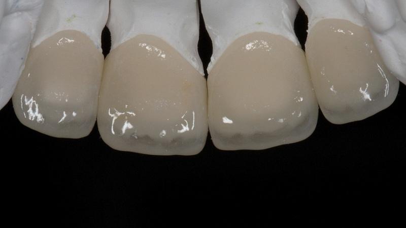 коронка из оксида циркония