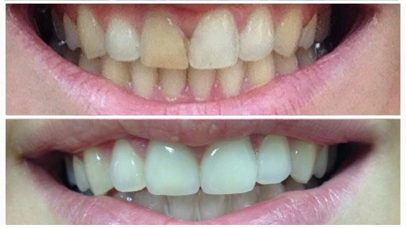керамические коронки на передние зубы фото до и после