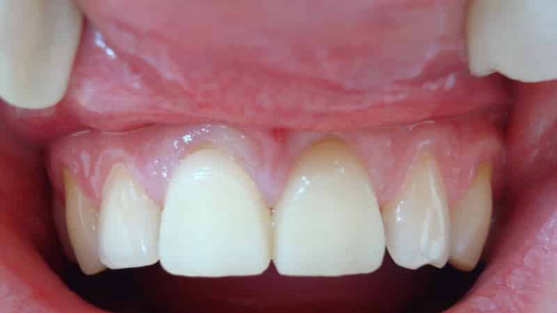 пластмассовые коронки на передние зубы отзывы