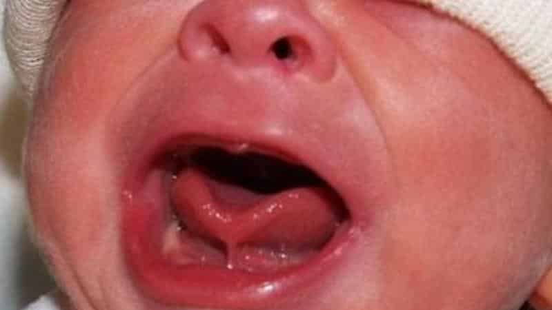 короткая уздечка языка у ребенка как определить