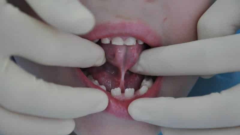 уздечка под языком у ребенка