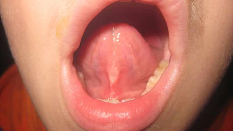 короткая уздечка языка у ребенка фото