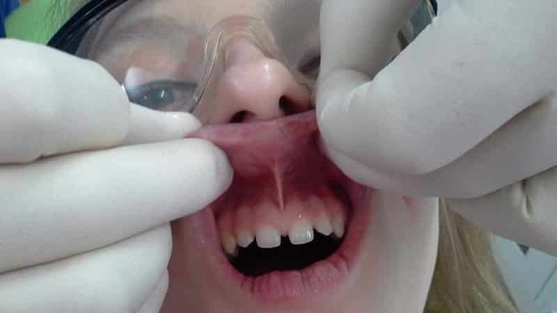 короткая уздечка верхней губы у ребенка