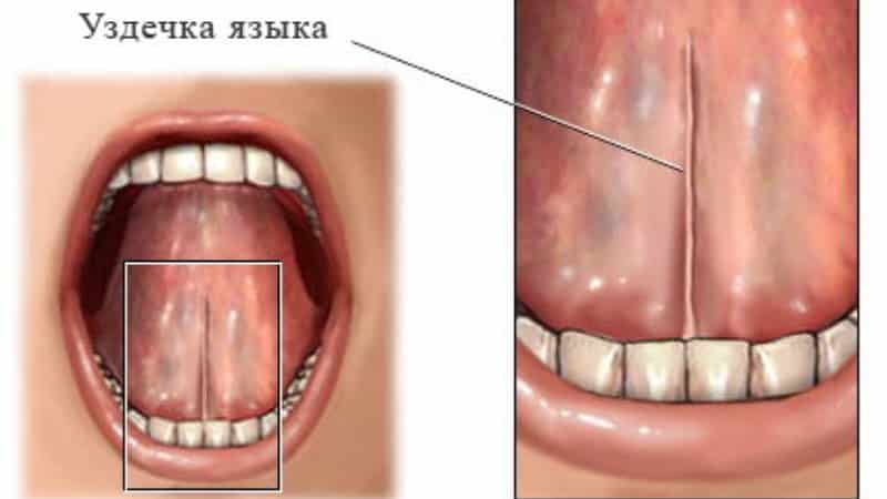 короткая уздечка верхней губы у ребенка