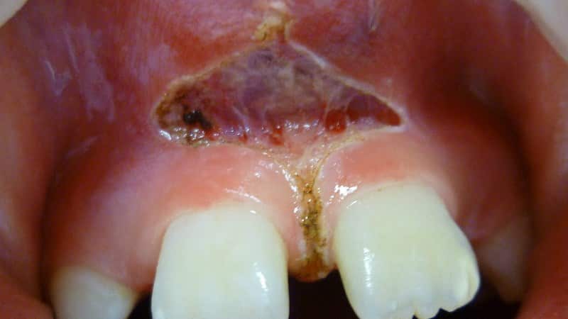 подрезание уздечки верхней губы у детей