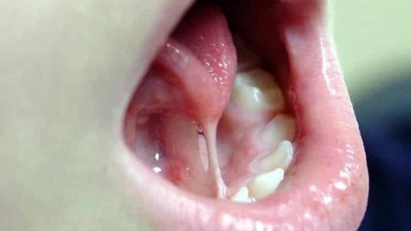 подрезание уздечки верхней губы у детей