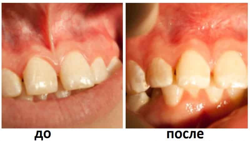 удаление уздечки верхней губы