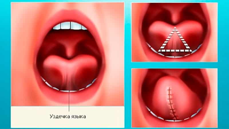 удаление уздечки верхней губы