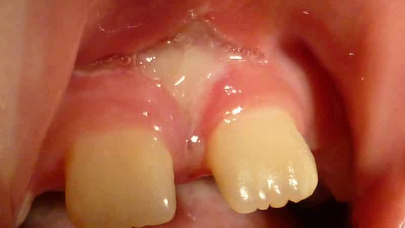 подрезать уздечку верхней губы ребенку