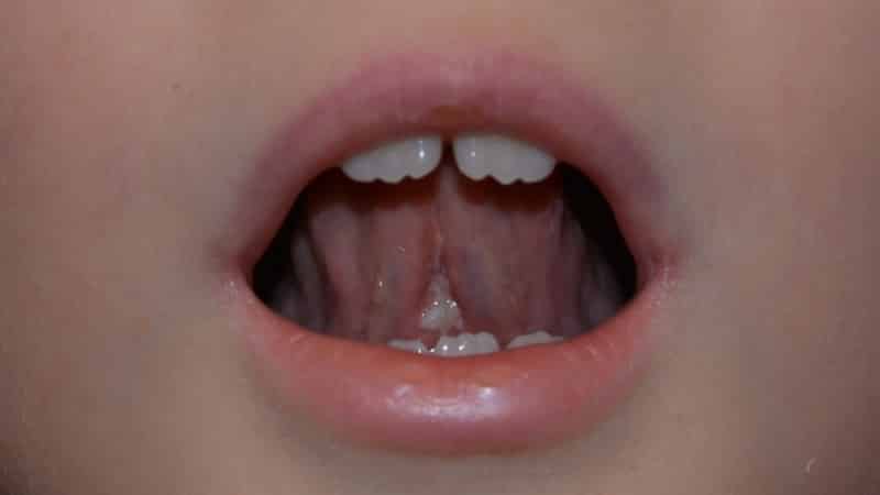 нужно ли подрезать уздечку верхней губы