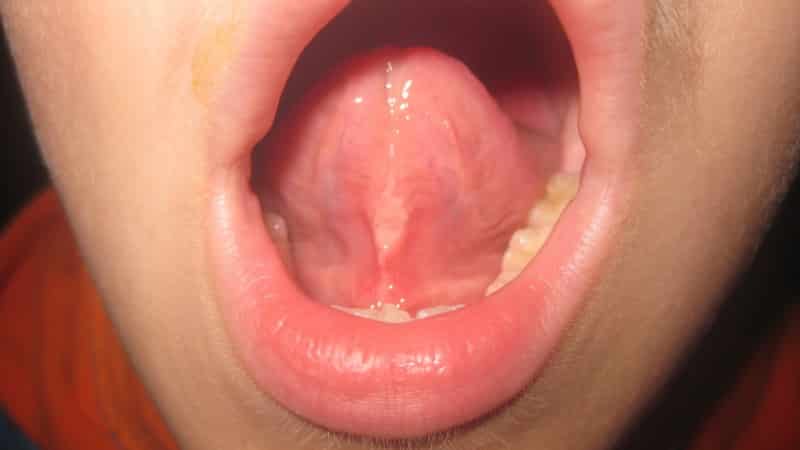 коррекция уздечки верхней губы