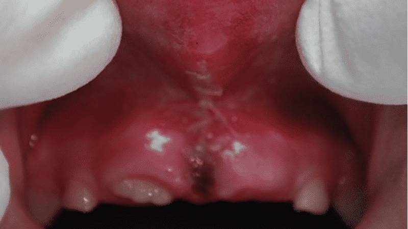 подрезание уздечки губы