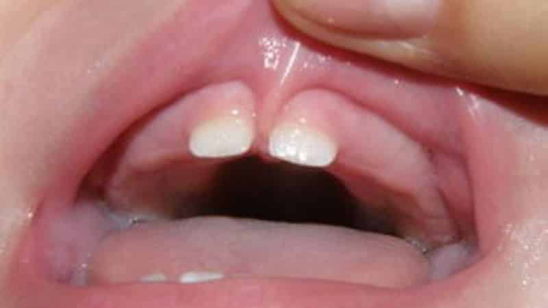 как подрезают уздечку верхней губы