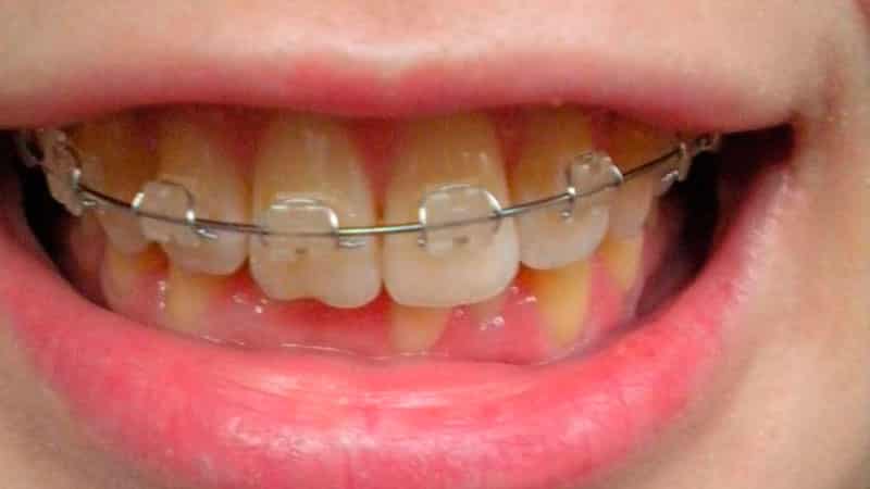 Как исправить глубокий прикус