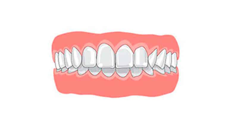 Исправление глубокого прикуса