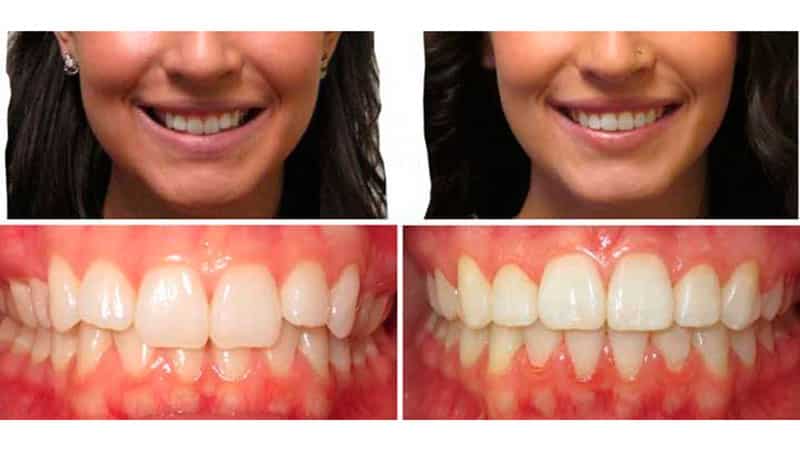 как исправить глубокий прикус