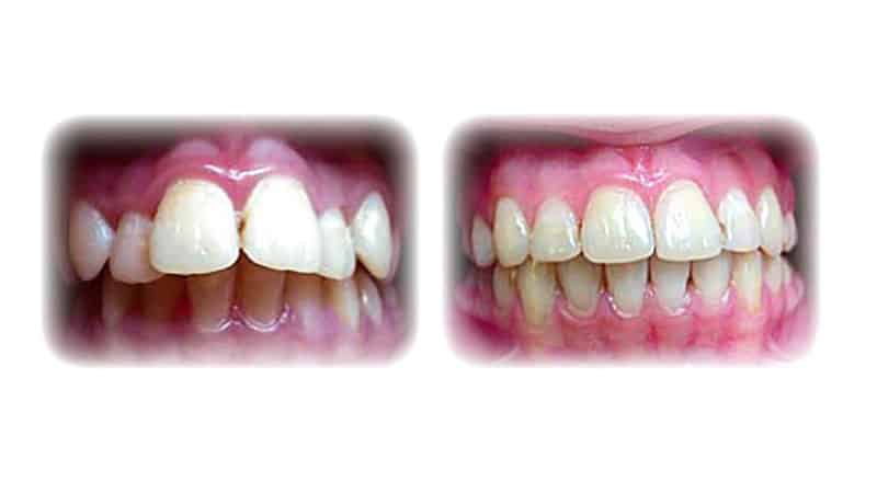 Глубокий прикус