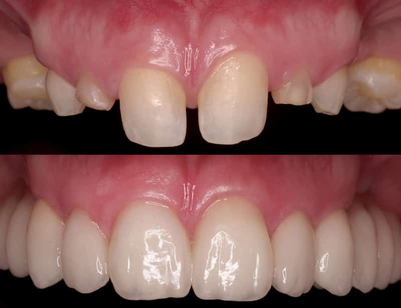 Вставные зубы фото до и после