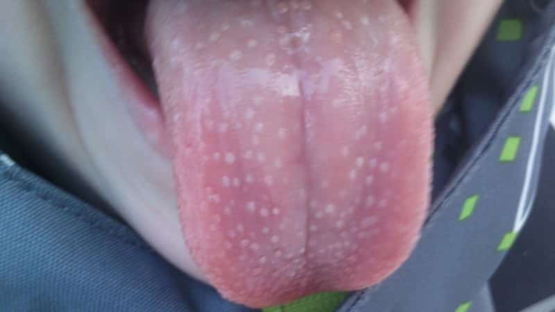 белый налет на языке появились красные пупырышки фото