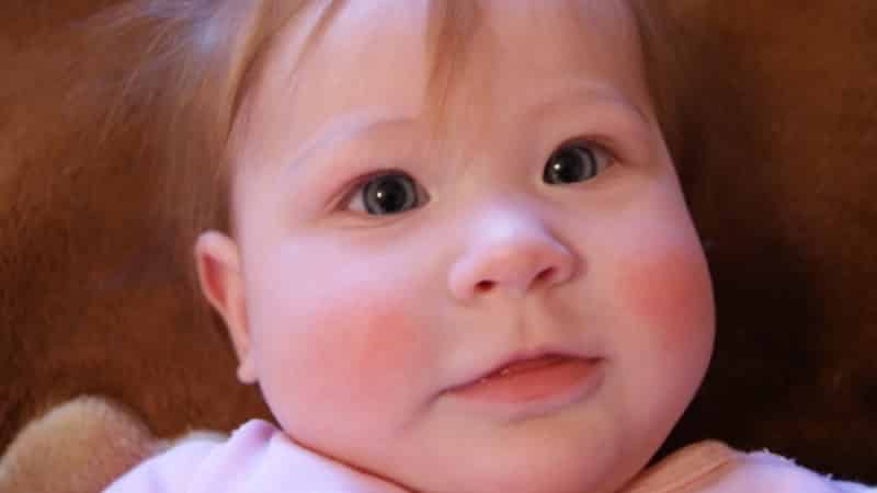 красные щеки у грудничка причины