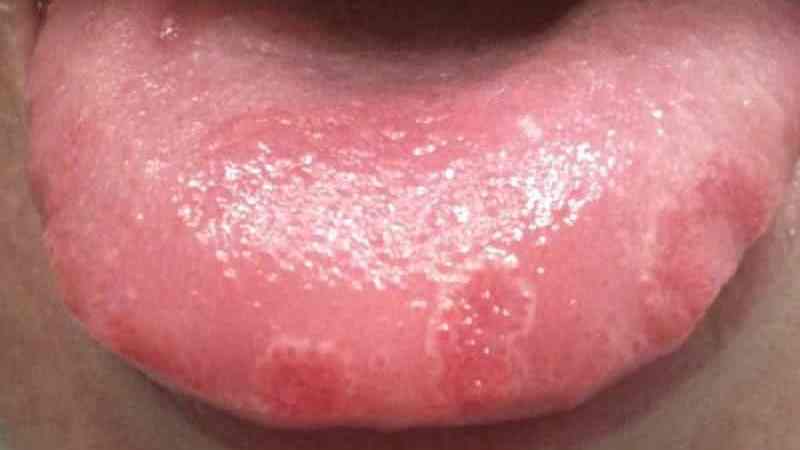 маленькие красные точки на языке причины