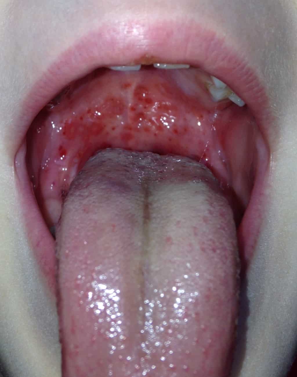 на небе красные точки пятна во рту сыпь на верхнем небе у ребенка взрослого фото