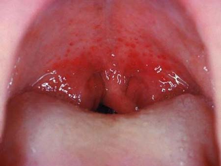 красная сыпь во рту на небе увзрослых