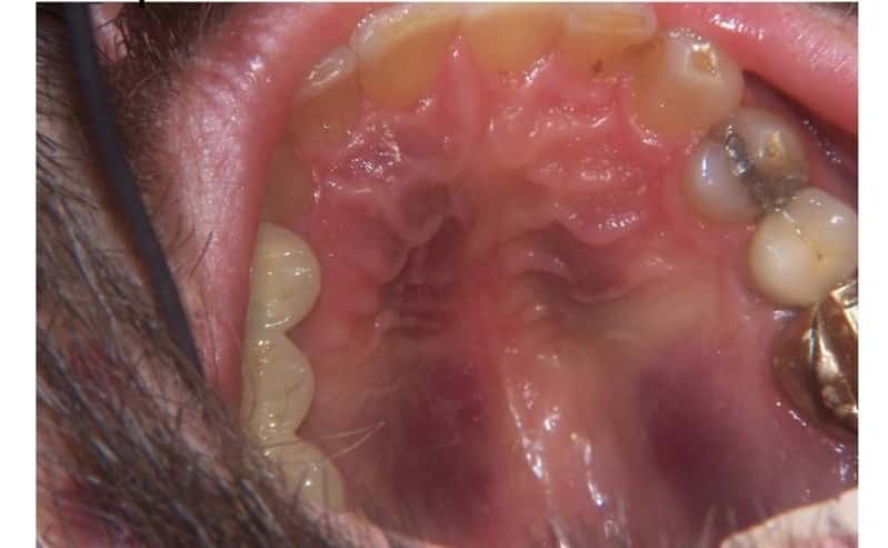 красная сыпь во рту на небе увзрослых