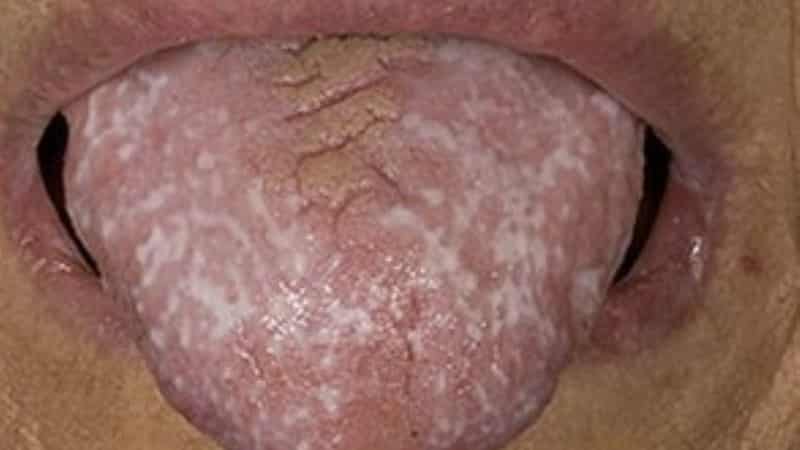 плоский лишай в полости рта