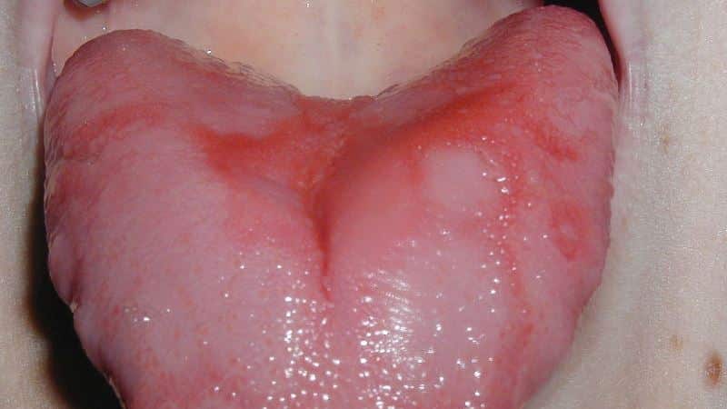 красный язык причины красного языка