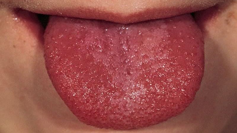 красный кончик языка причины