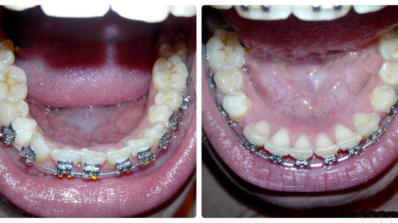 Исправление кривых зубов