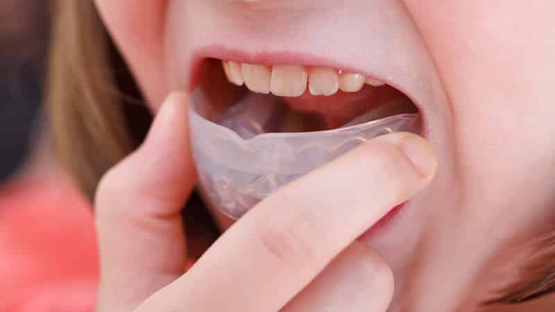 Исправление зубов без брекетов у детей