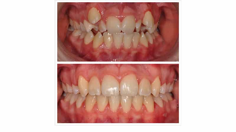 Кривые зубы фото