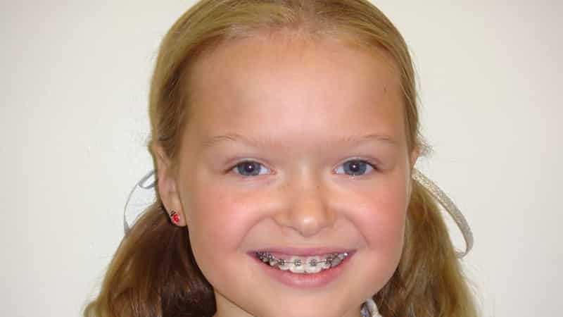 У ребенка криво растут зубы