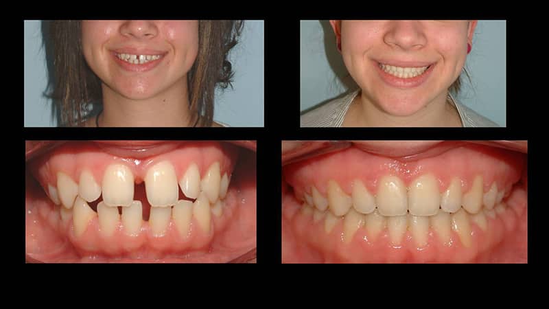 Как исправить кривые передние зубы