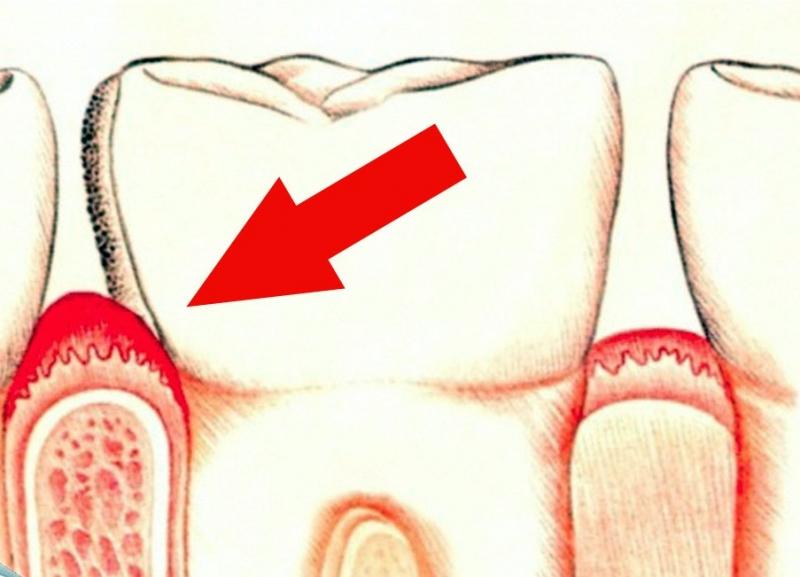 кровь во рту по утрам причины