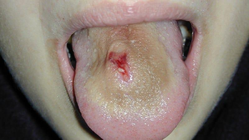 кровяной пузырь на языке фото