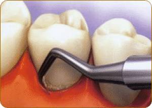 Кюретаж Кюретаж