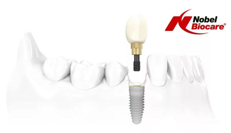 Какие существуют виды имплантатов Nobel Biocare и в чем их преимущества