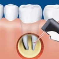 Лечение кисты резекцией Лечение кисты резекцией