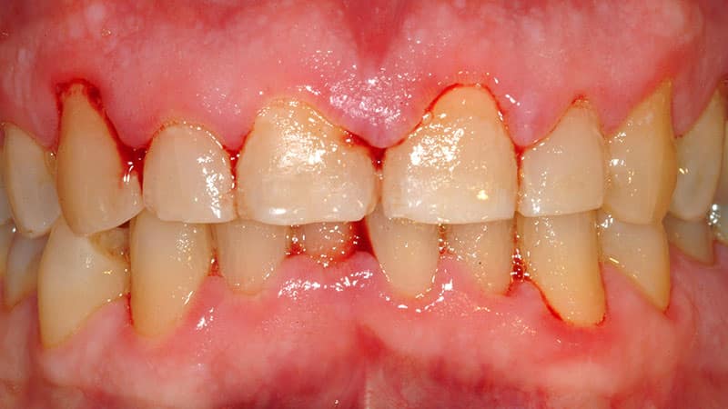 Лечение кровоточивости десен