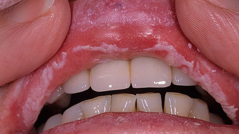 Как вылечить молочницу на губах у взрослого