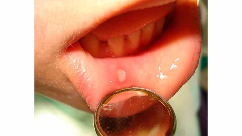 Как вылечить стоматит на губах