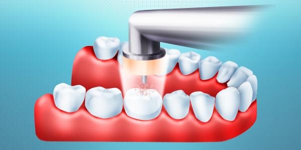 Лечение озоном Лечение озоном