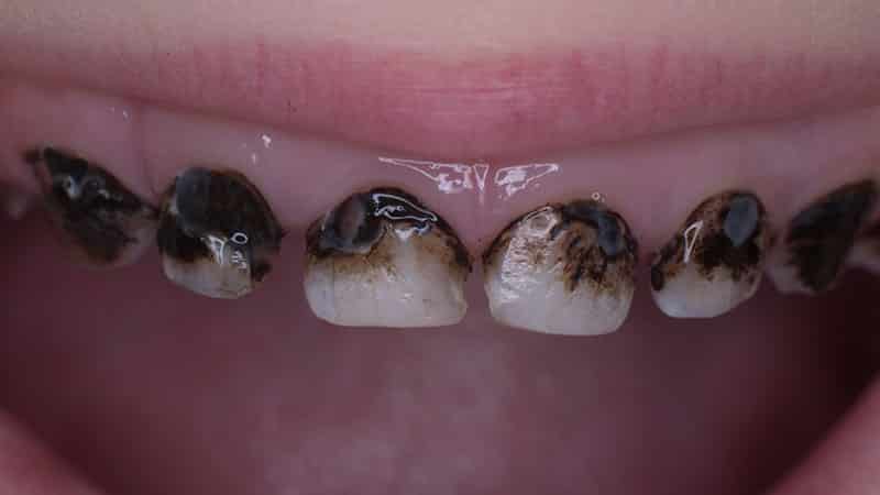 Порченные молочные зубы