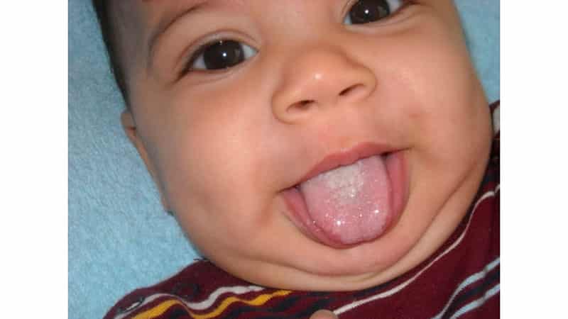 Как вылечить налет у малыша