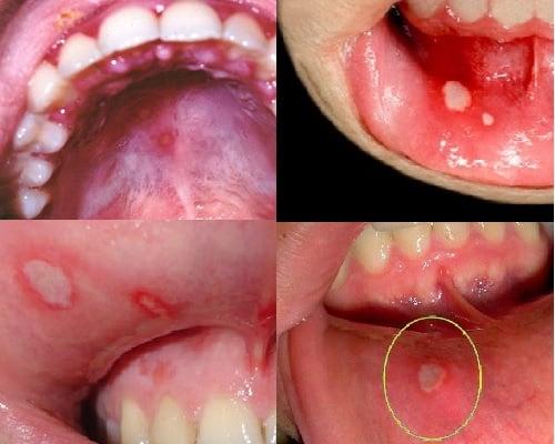 стоматит как лечить в домашних условиях