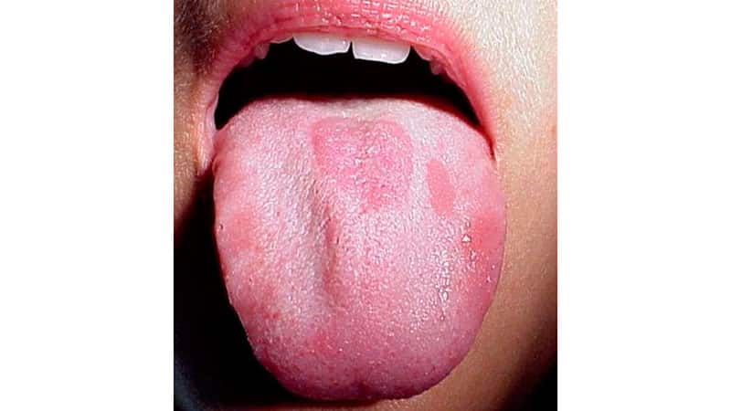 Как вылечить молочницу на языке