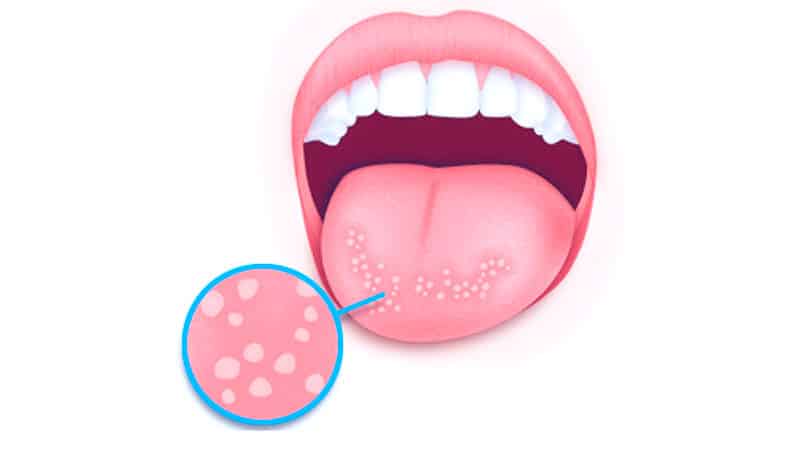 Лечим стоматит во рту